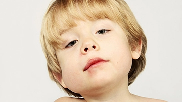 Kabakulak Belirtileri ve Tedavisi